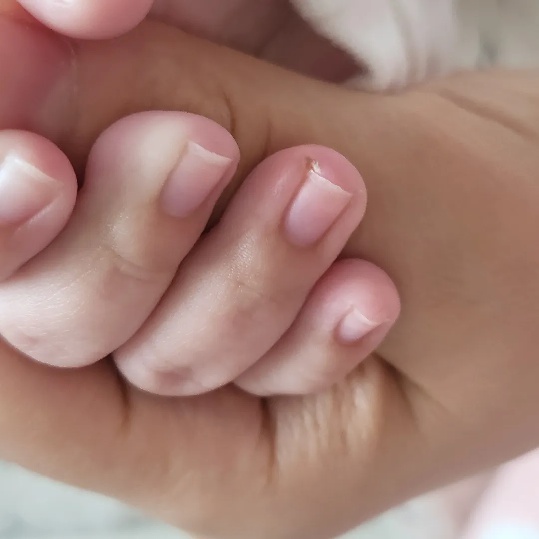 아기 손톱이 살을 파고들어요 굳어버린 살 정상으로 돌아올까요?