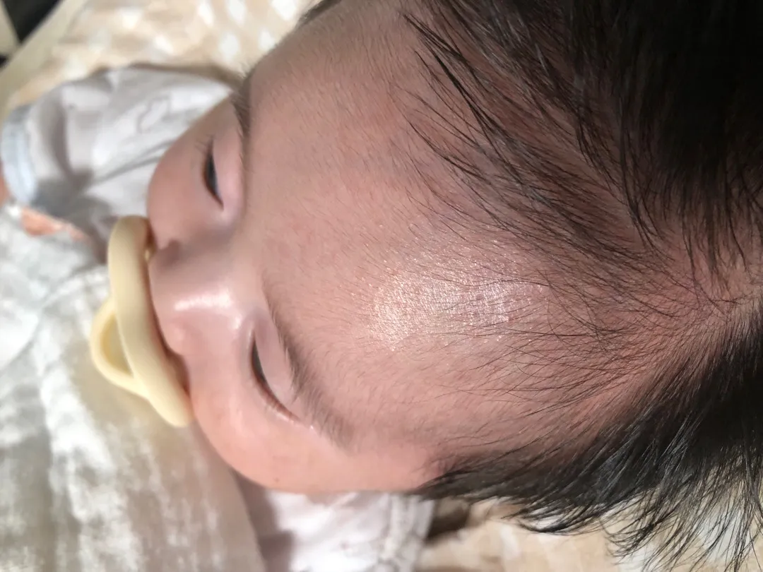 좁씰여드름바스추천해주세요
