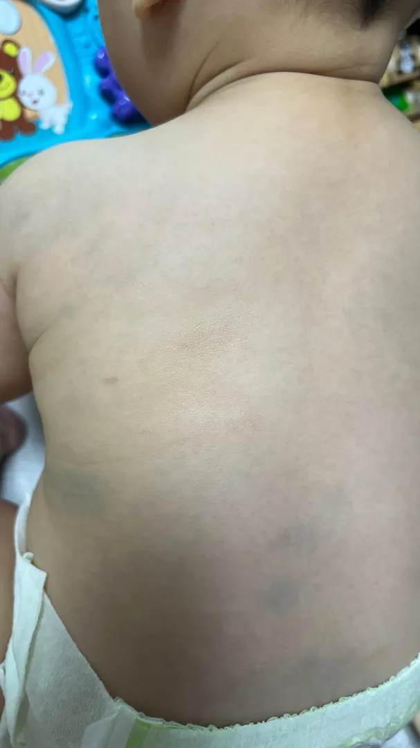 혹시 저희 아가같이 등에 나는 아가 있을까요😭