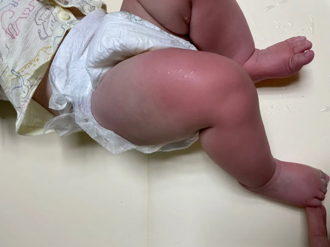 아기 다리만 갑자기 빨개졌어요ㅠㅠ경험있으신분!