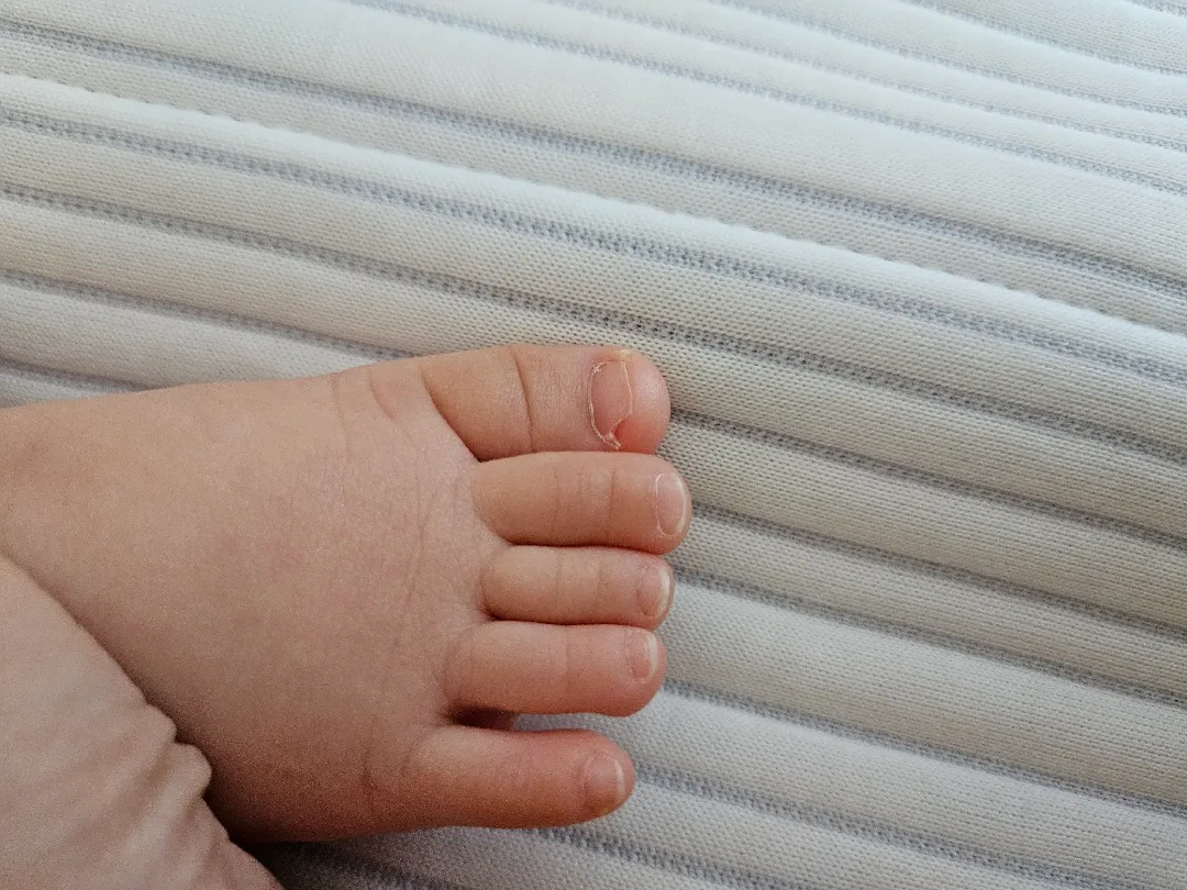 애기발톱이 깨졌는데 괜찮을까요?