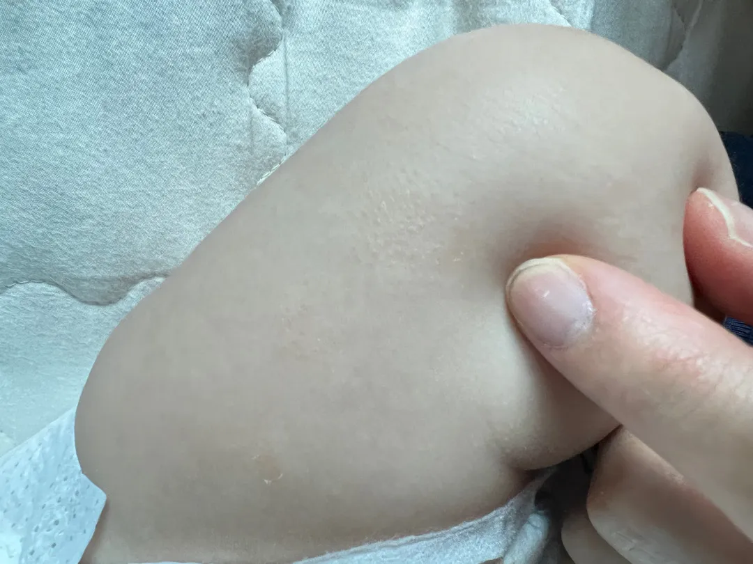 아기 피부가 건조해서 그런걸까요ㅠ??
