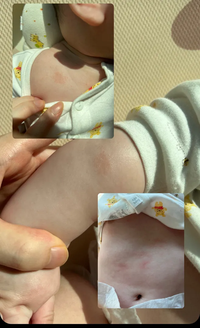 [사진있음] 피부 두드러기? 건선?