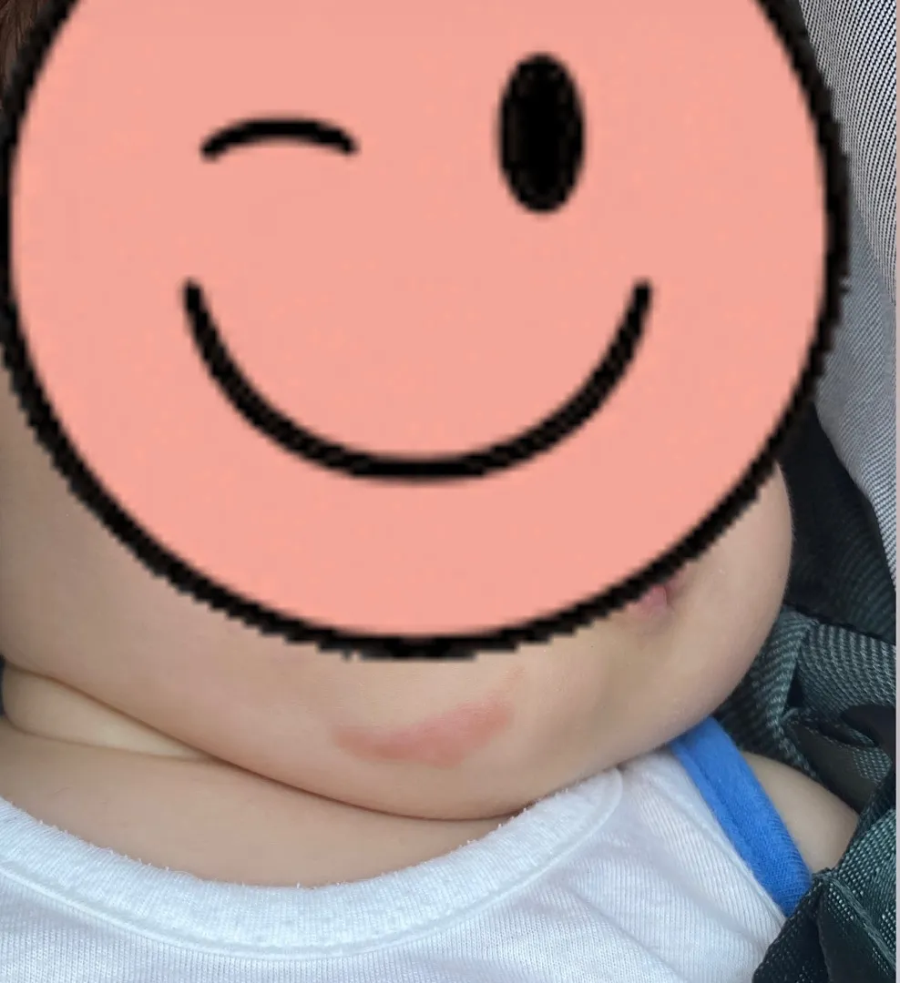 아기피부 봐주세요ㅠㅠ
