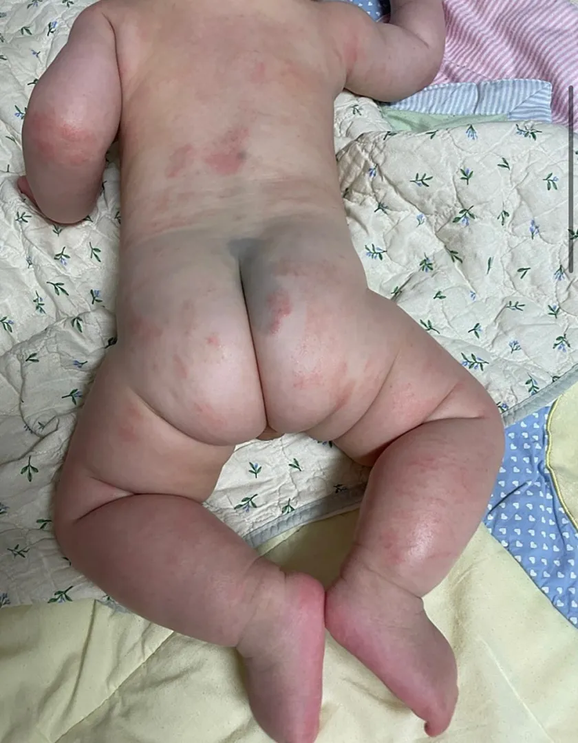 6개월된아기 가끔씩 몸에 빨갛게 피어있네요