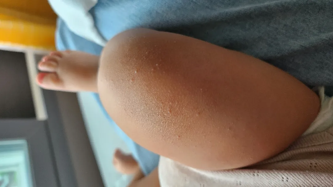 양쪽 다리에 오돌토돌하게 뭐가 났어요ㅠ