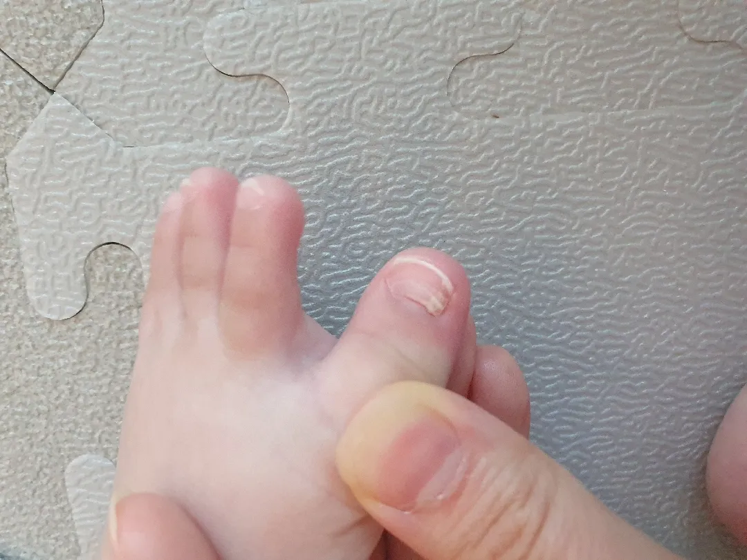 아기발톱 봐주세요 ㅠ