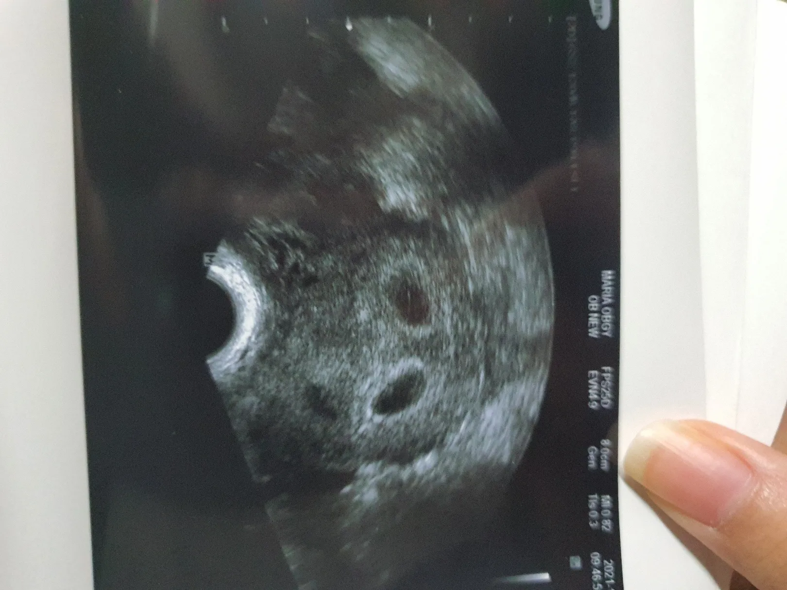 6주0일 시험관 둥이 초음파