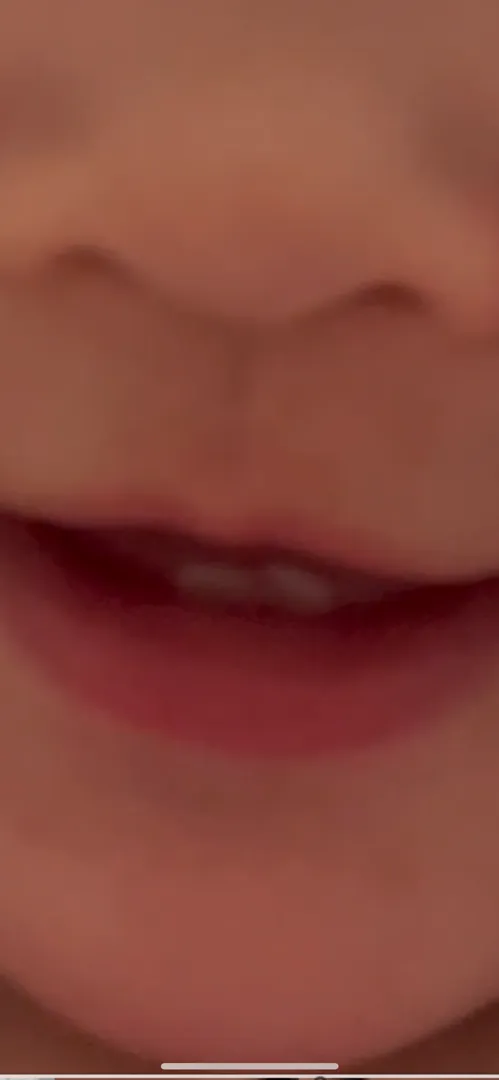 아랫니 난게 살짝 삐뚠거 같아여ㅠㅠㅠ