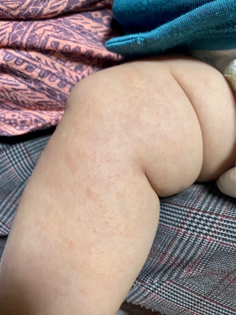 피부