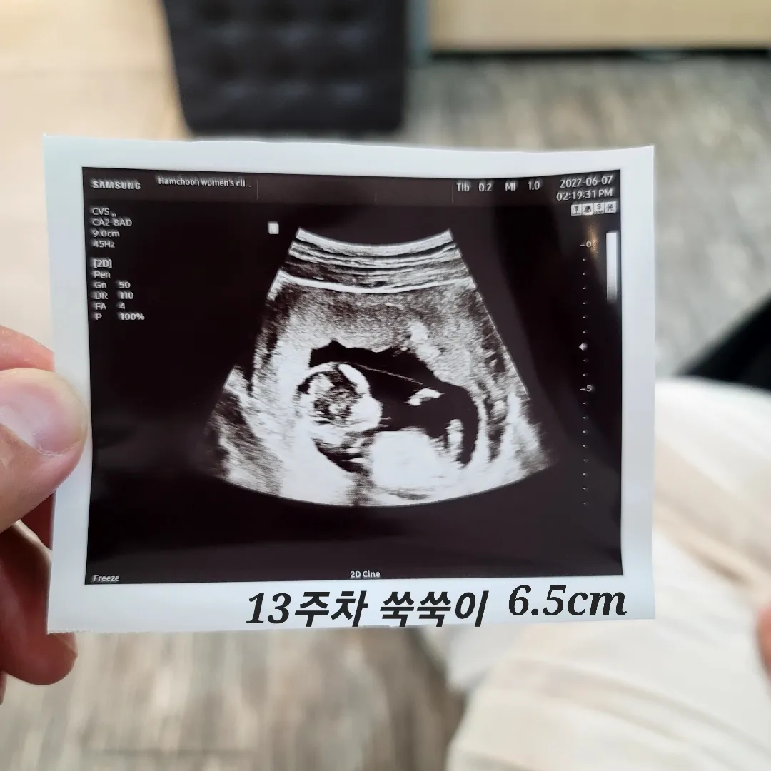 13주차 염색체검사 결과는 딸!