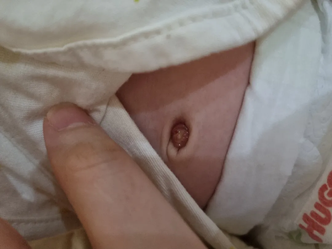 생후 37일 배꼼떨어졌는데 육아종일까요?