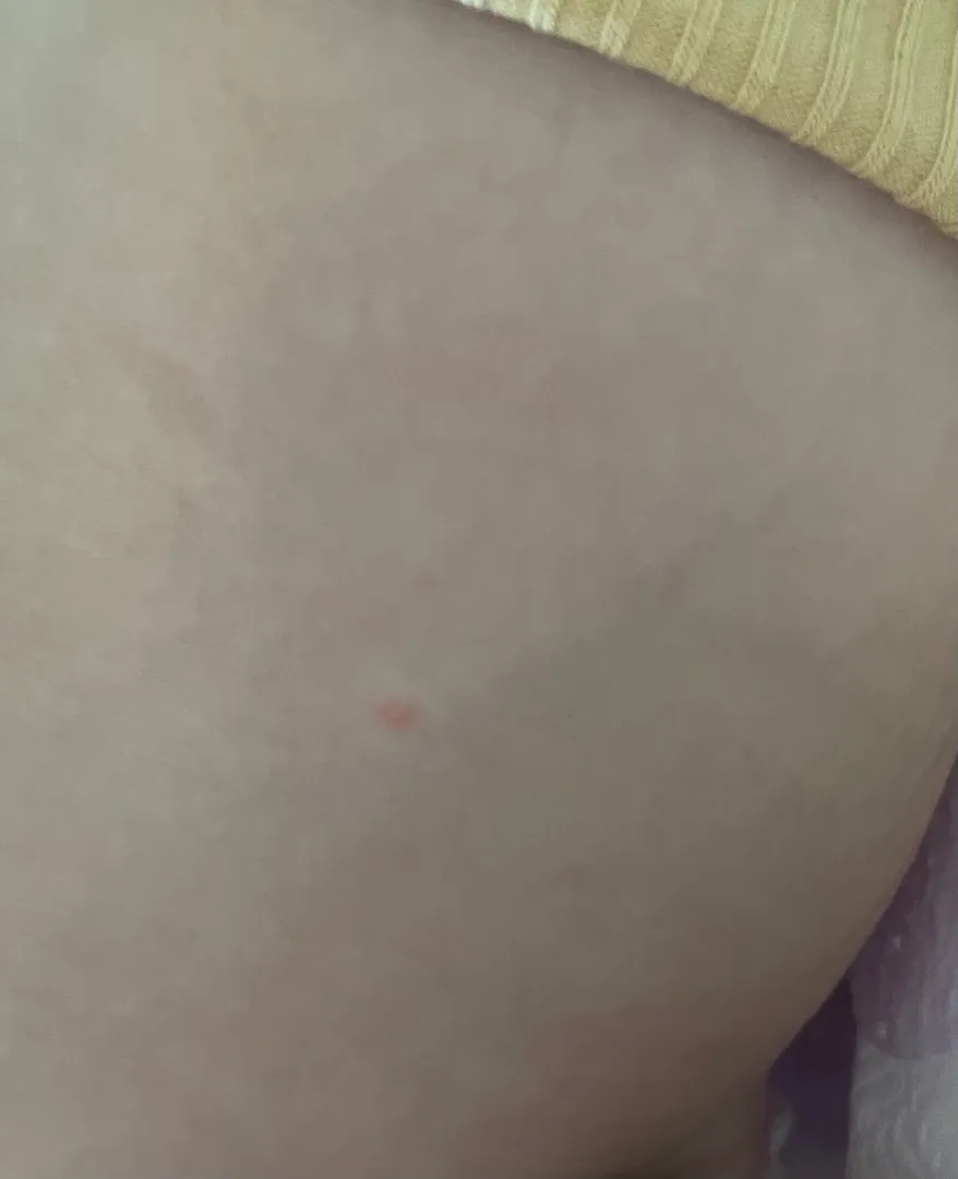 아기배에 붉은 점