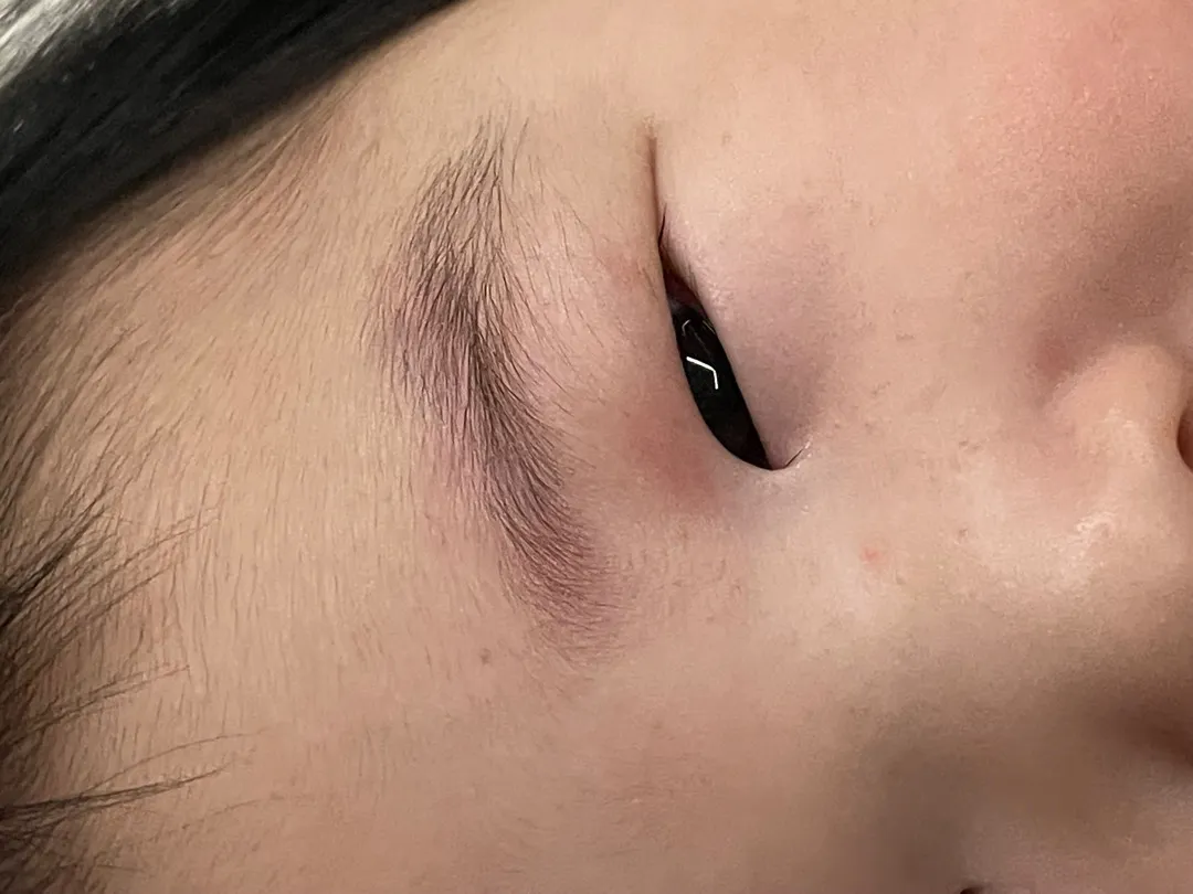 분유알레르기