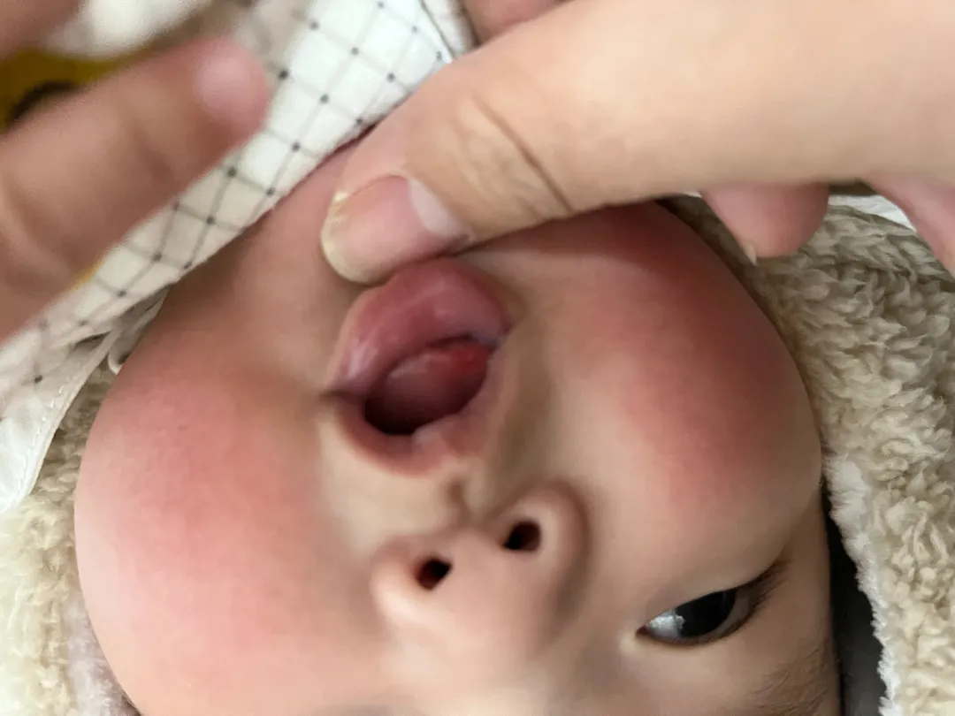 애기 혀끝이 빨개요