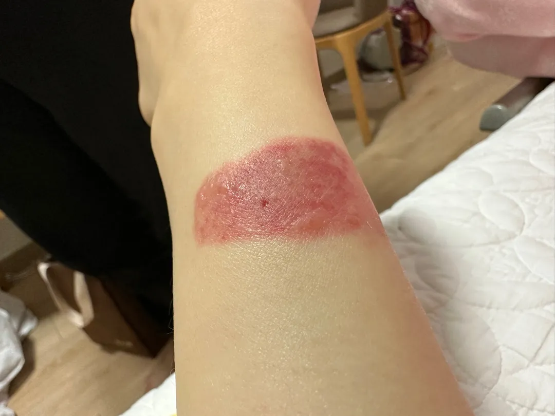 (사진주의)자분 후 링겔 자국ㅠㅠ