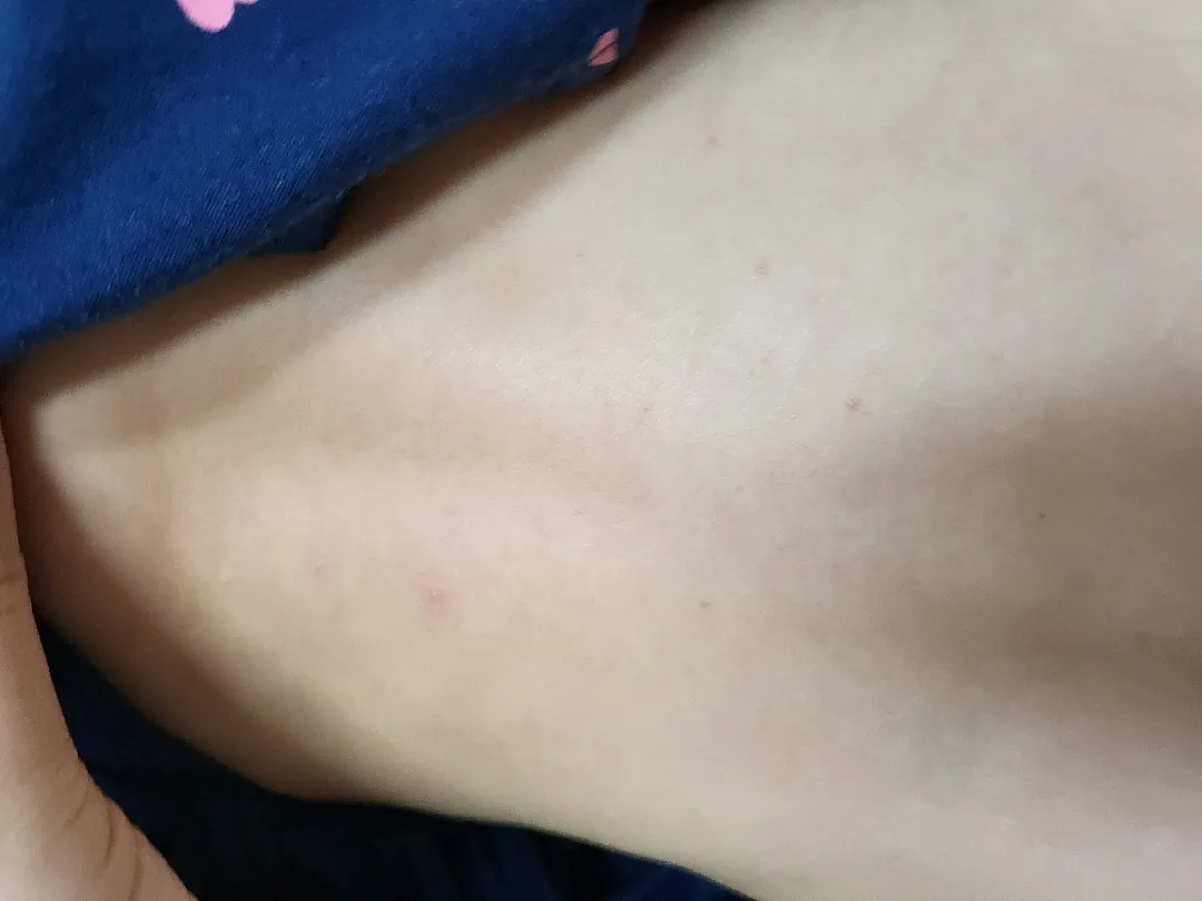 땀띠일까요 알러지일까요?ㅠㅠ 선배맘님들 계신가용...