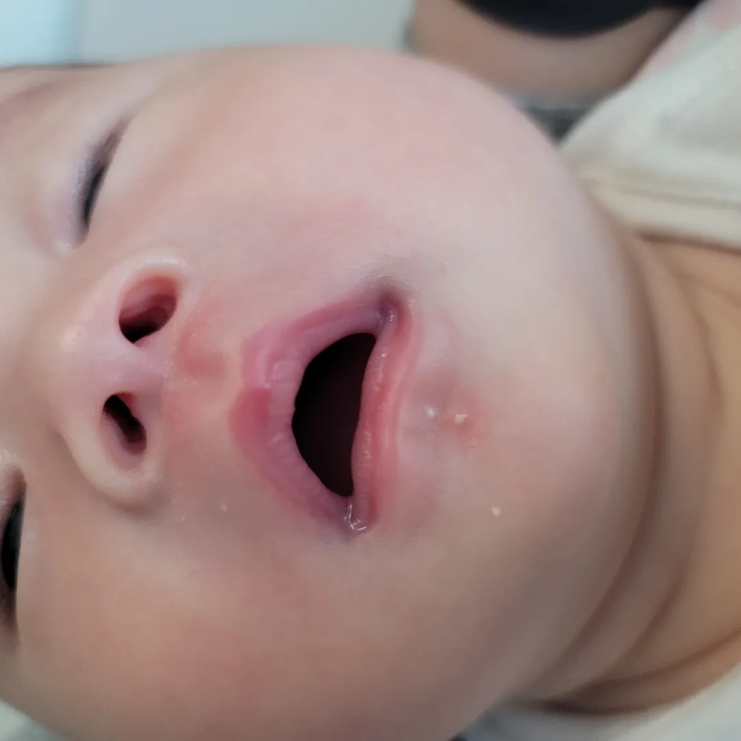 좁쌀여드름..?