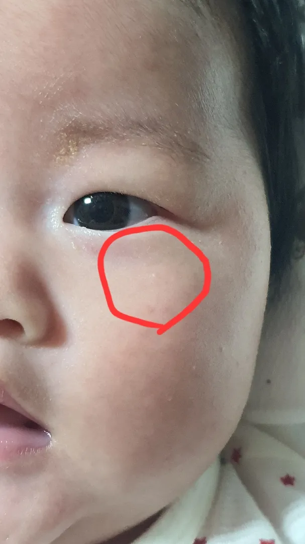 하얀 좁쌀 같이 생긴게 항문쪽에도  있는데  이게 멀까요?