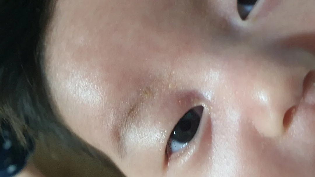 언제쯤 없어지나요?