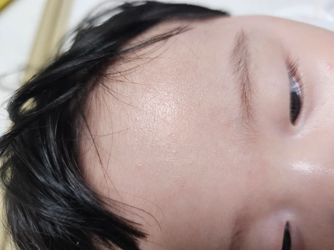 이마에  좁쌸여드름 인가요?