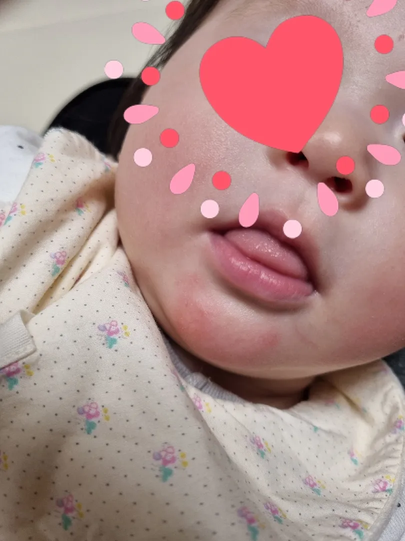 턱에 침독일까요?