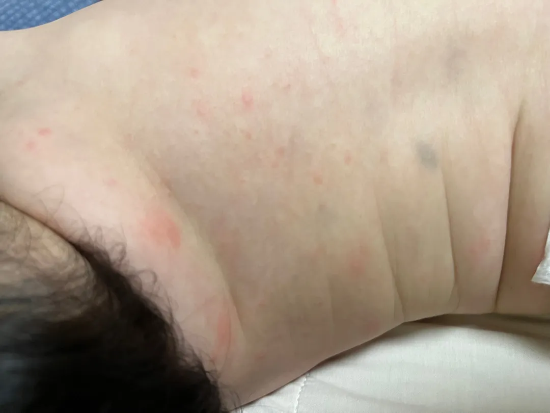 등 땀띠 