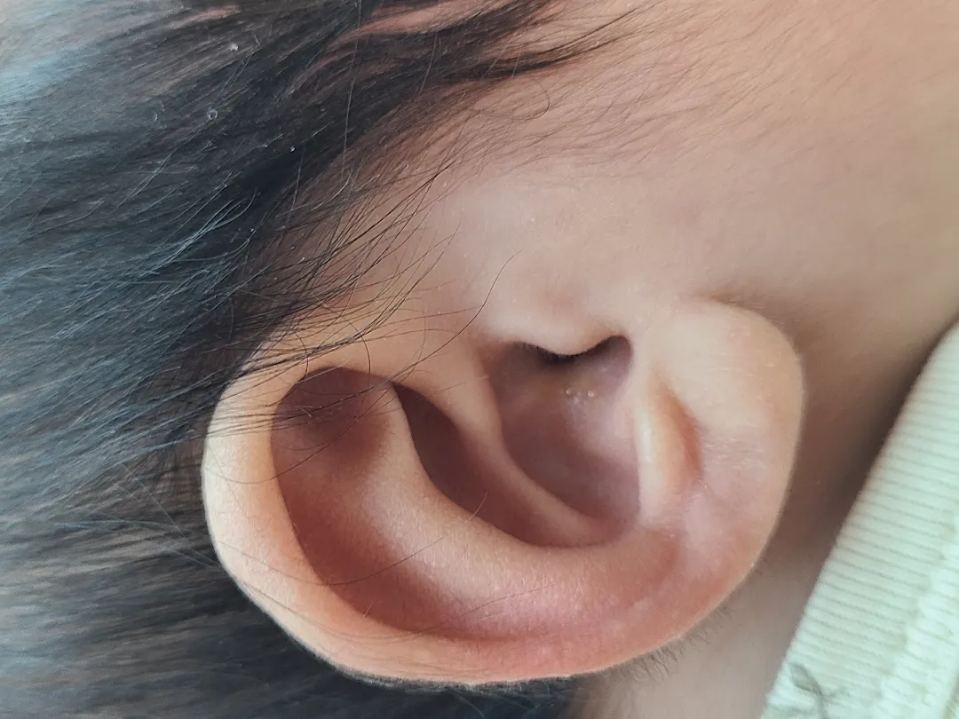 귀 수포 사진좀 봐주세요