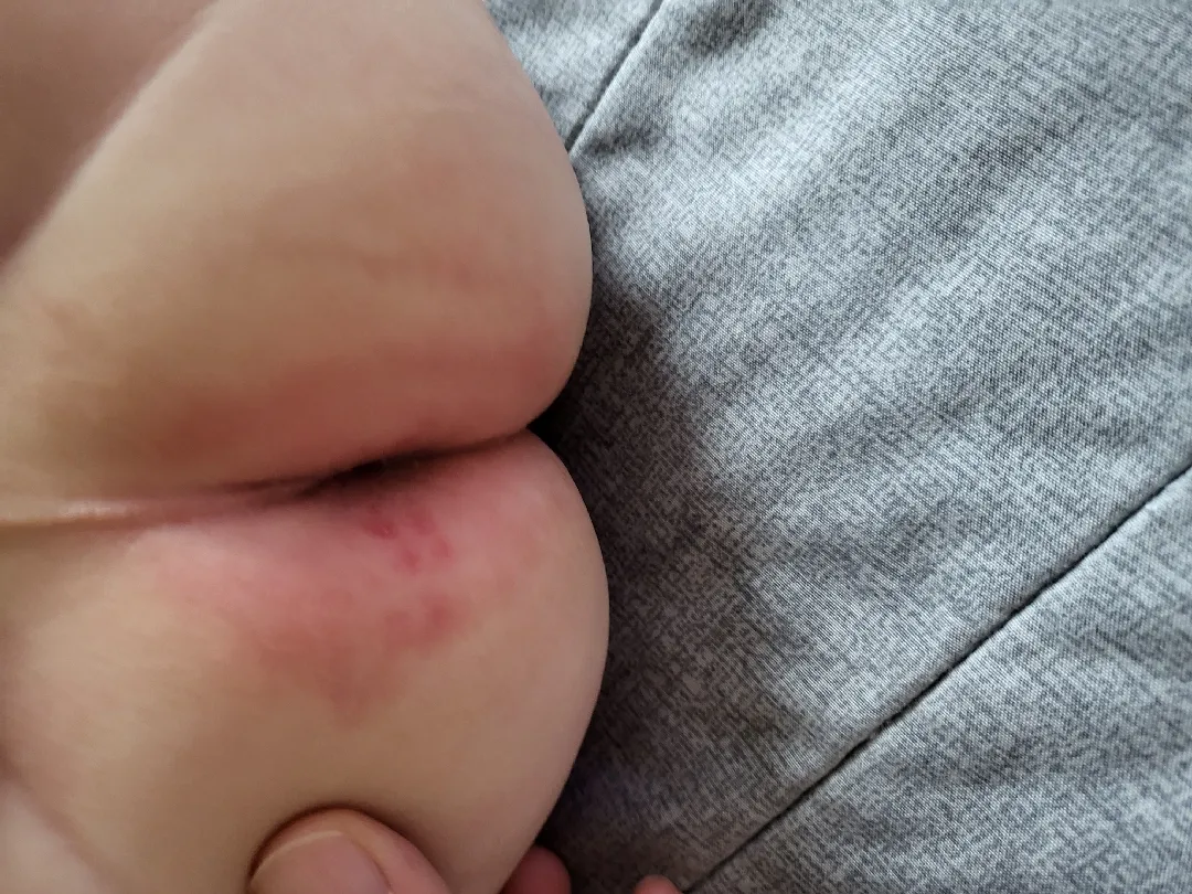 기저귀발진