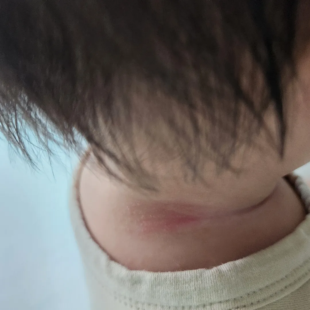 이게 땀띠인가요?