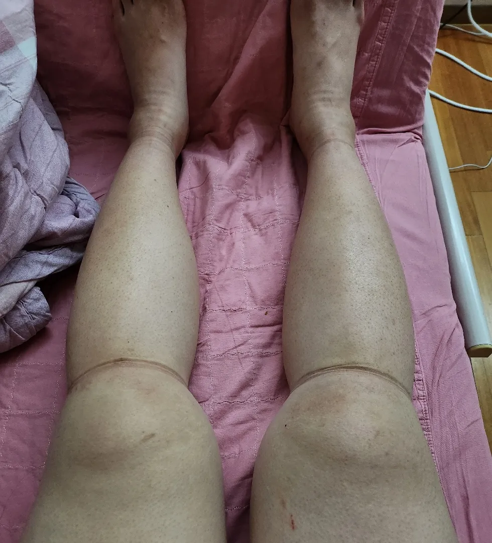 제왕절개 다리 붓기ㅠㅠ