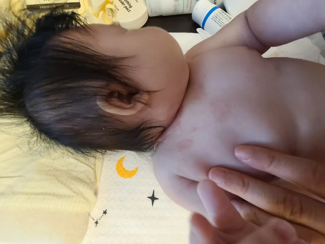 아토피인가요?ㅜㅜ