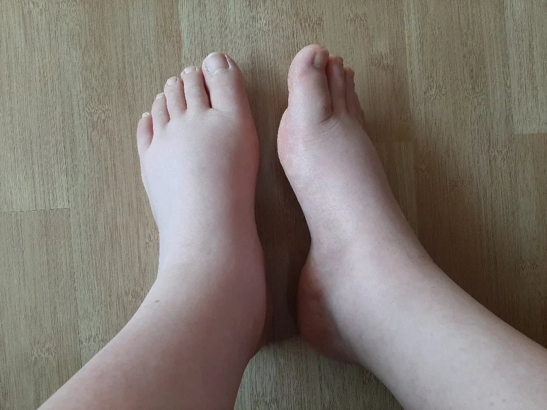 손,발 부종ㅠㅠ콜레스테롤수치!!!!