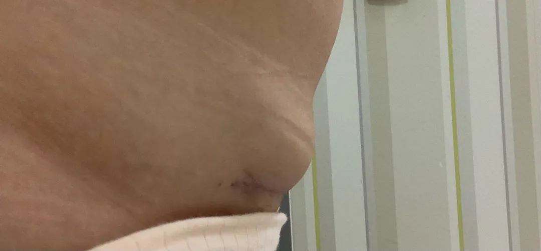 제왕절개 수술부위가 저 같으신 분 있으실까요..?