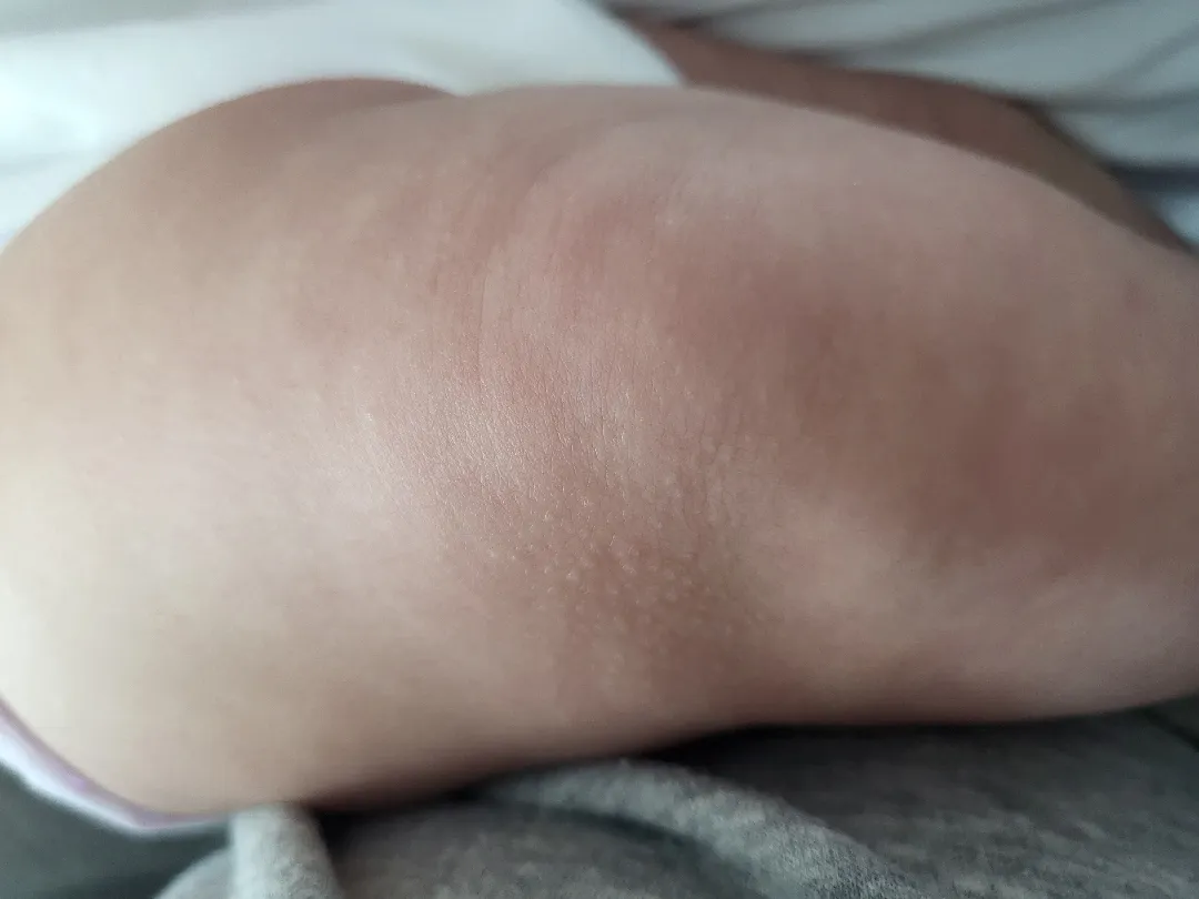 다리 피부에 뭐가 나네요ㅠ