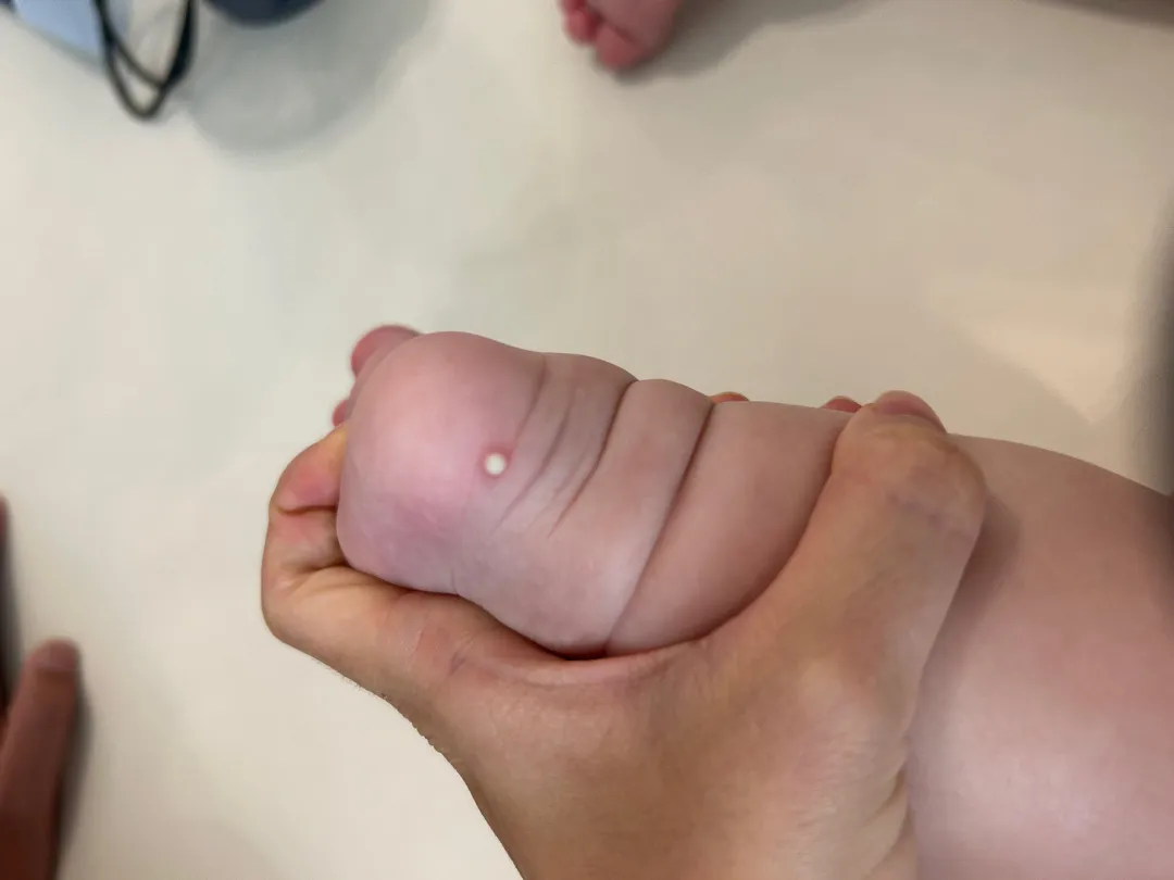 아기여드름인가요?(사진 0)