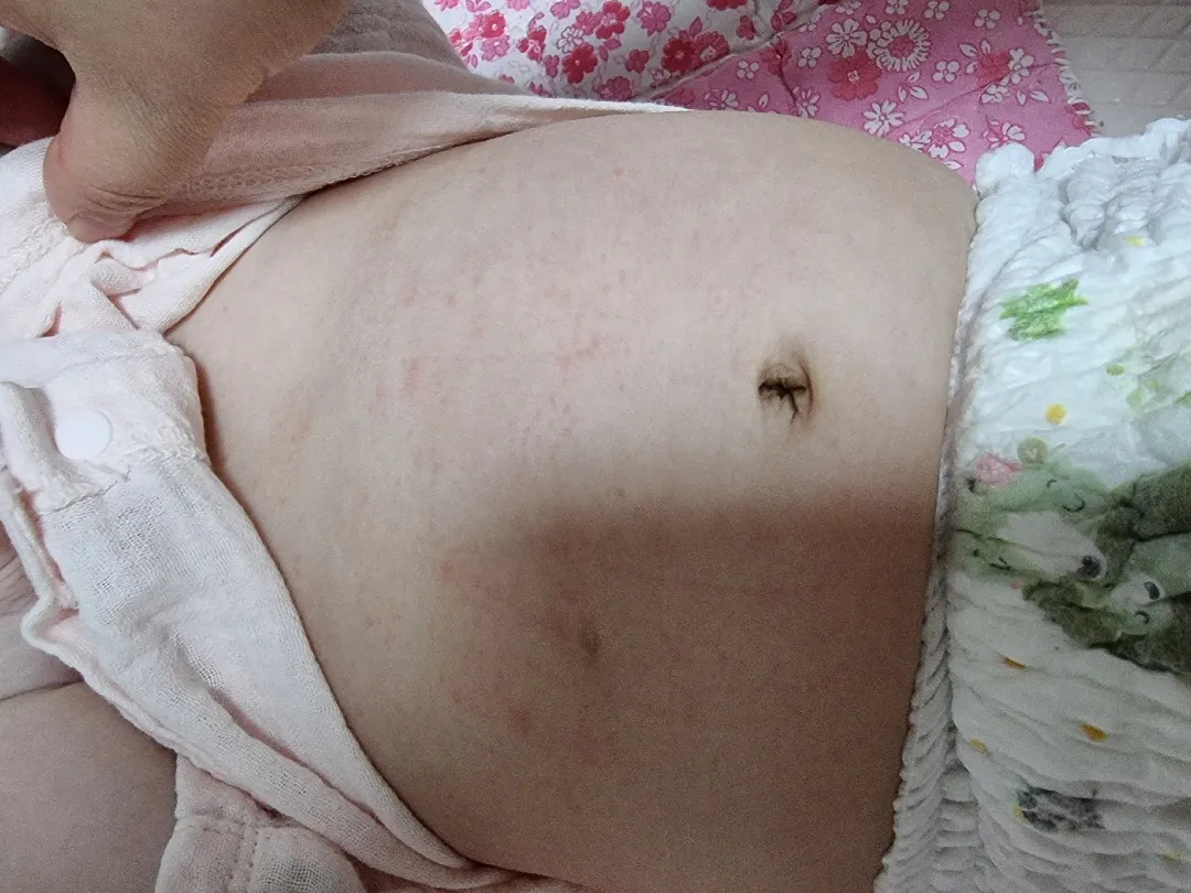 아기땀띠 자주나네요
