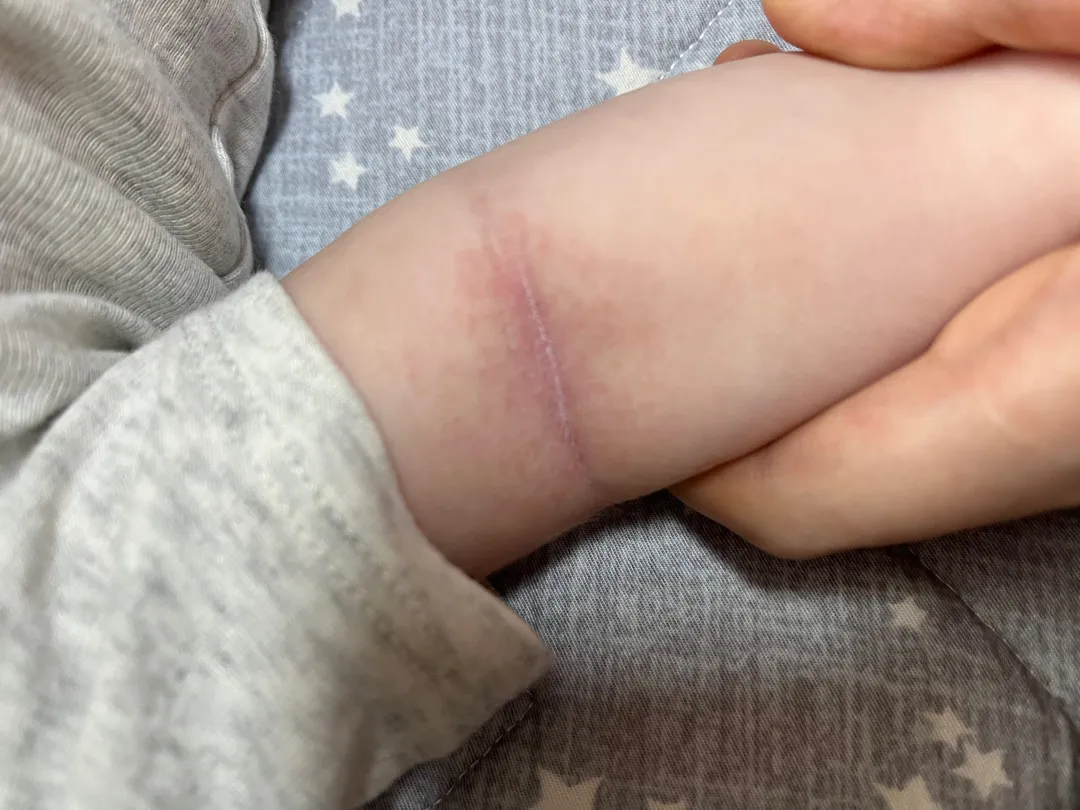 팔 안쪽 피부 봐주세요 ㅠㅠ