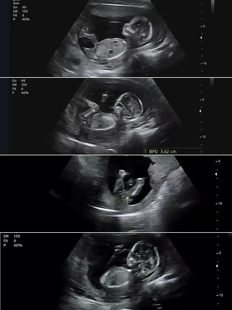 14주6일 각도법 고수님들 알려주세요 😊