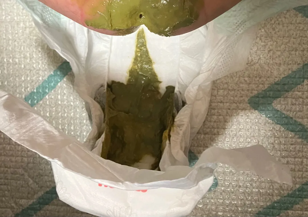 분유수유 아기 응가(녹변)