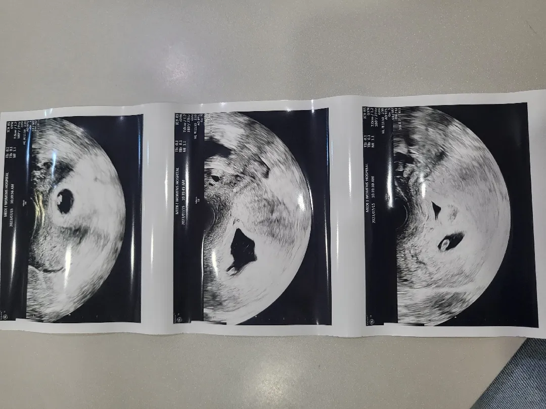 6주2일 쌍둥이