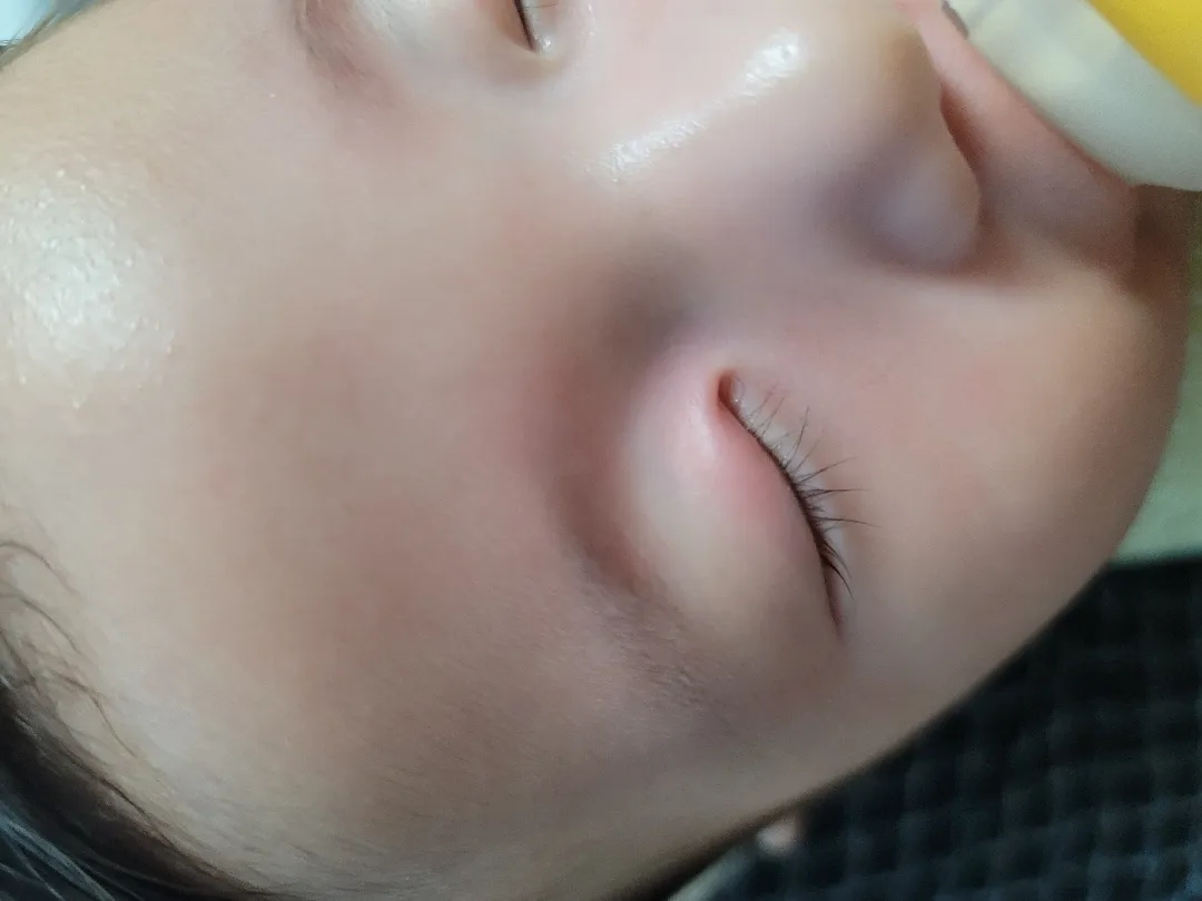 95일차 아기 모기물림