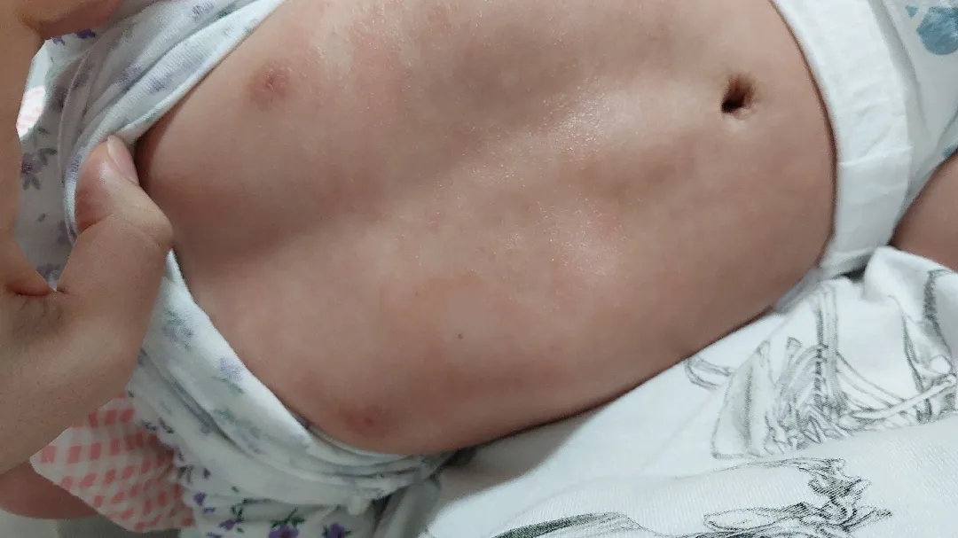 아기 피부 태열? 아토피?