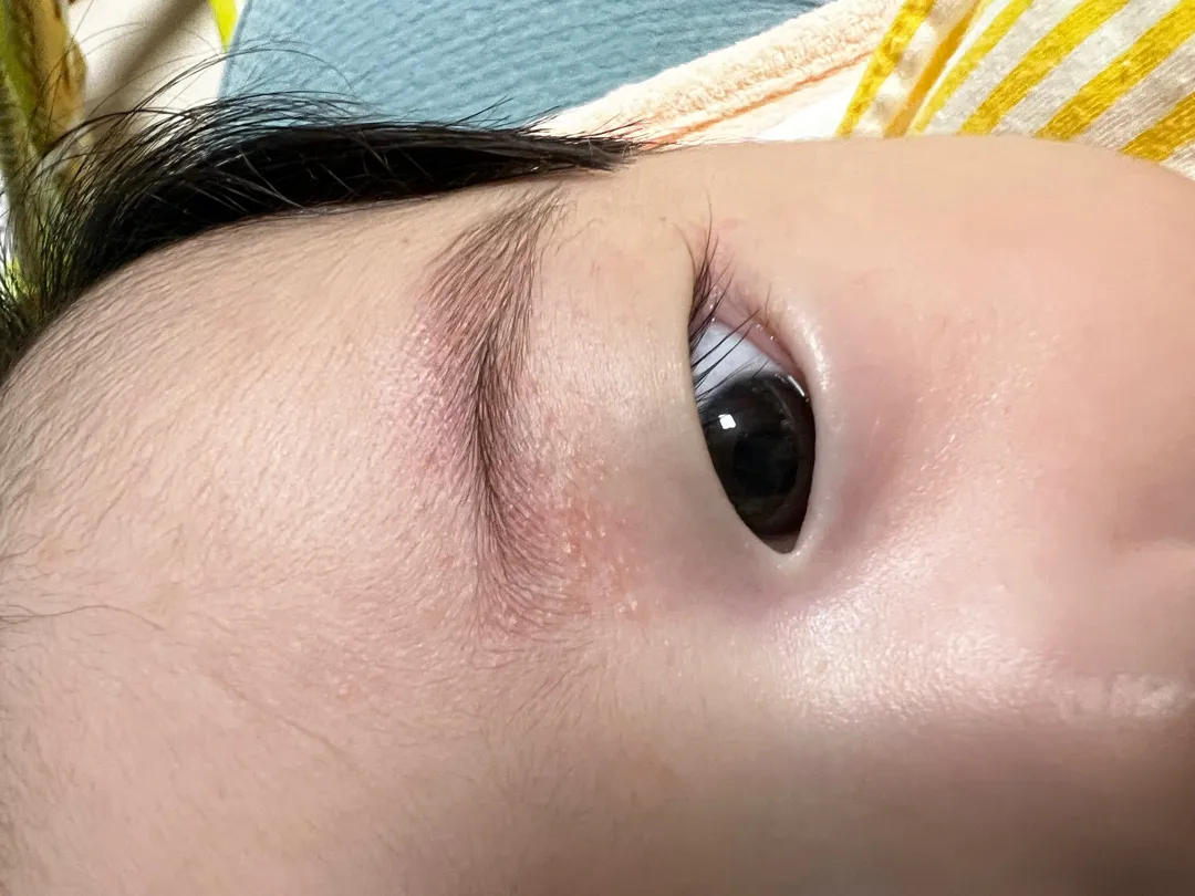 아기 눈썹에 알러지??