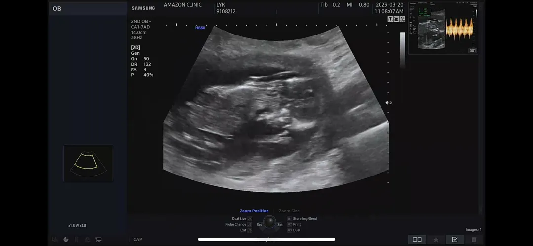13주1일(싸이즈는 13주3일) 여자 각도 맞나요!!