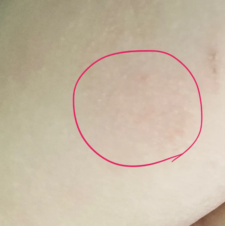 동전습진? 일까요ㅠㅠ