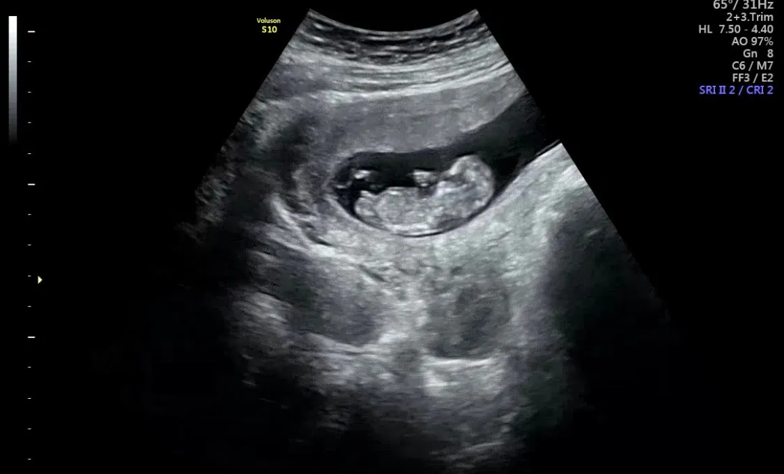 오늘 1차 기형아 검사 하고 왔어요~