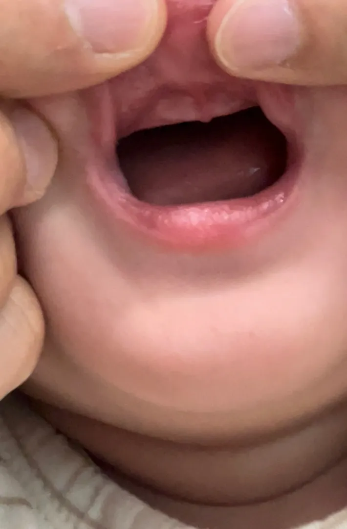 요거..윗니맞나요..?