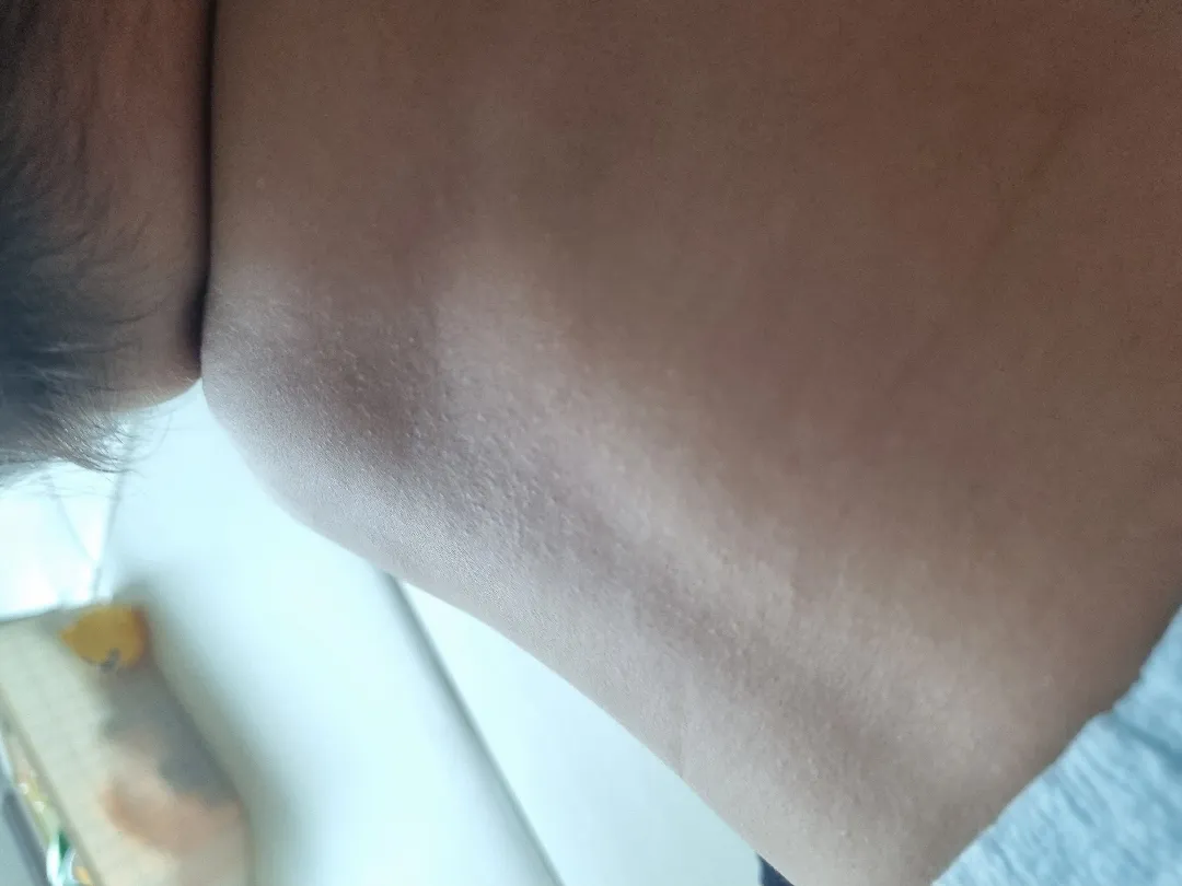 보통 이건 땀띠인가요?
