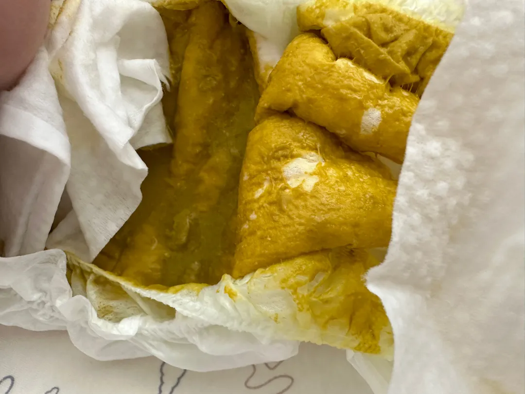 아기 설사(사진 있음)